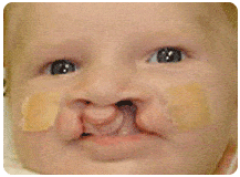 An image of a baby with duoderm on.