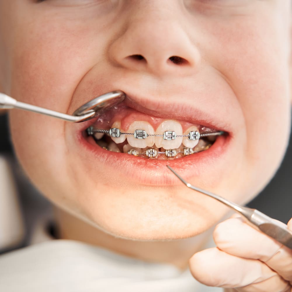 Orthodontic Emergencies, Vancouver Orthodontic