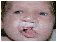 An image of a baby wearing liptape