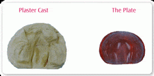 Cleft Treatment, Mould and Plate